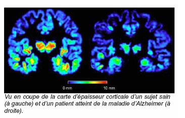 Vers une détection anticipée de la maladie d'Alzheimer ?