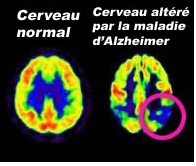 Alzheimer : découverte de la « protéine de l’oubli » - Source de l'image:http://www.rfi.fr