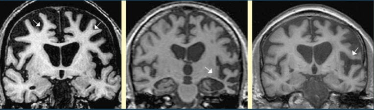 Découverte d'un gène associé à la démence fronto-temporale -Source de l'image: http://www.neuroland.biz