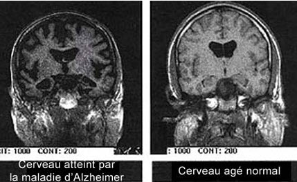 Alzheimer : les enjeux de la recherche - Source de l'image : http://www.rfi.fr