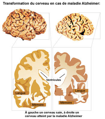Alzheimer : Le cerveau se rétrécit 10 ans avant le diagnostic - Source de l'image: http://storage.canalblog.com